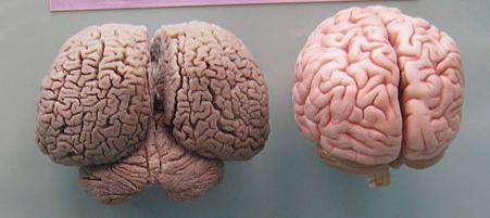 Cel din stanga e creier de deflin, cel
din dreapta e creier uman